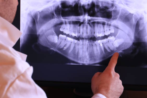 Best Emergency Root Canal Treatment in South Venice, FL